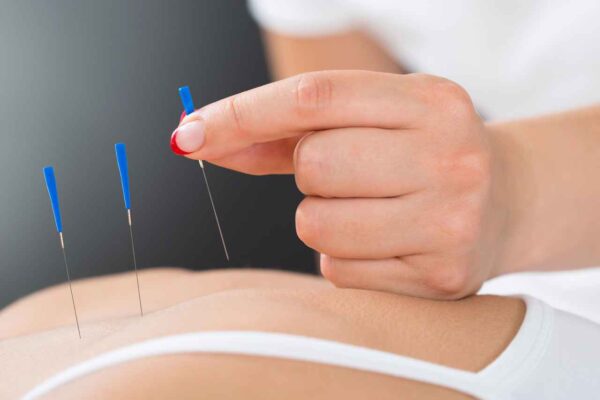 Acupuncture Toronto