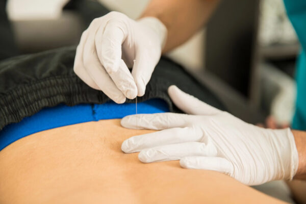 Dry Needling Port Credit mississauga