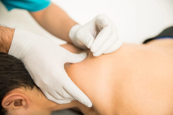 Dry Needling Port Credit mississauga