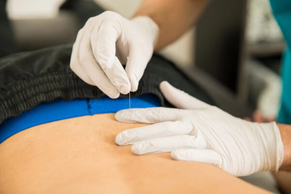 Dry Needling in Toronto