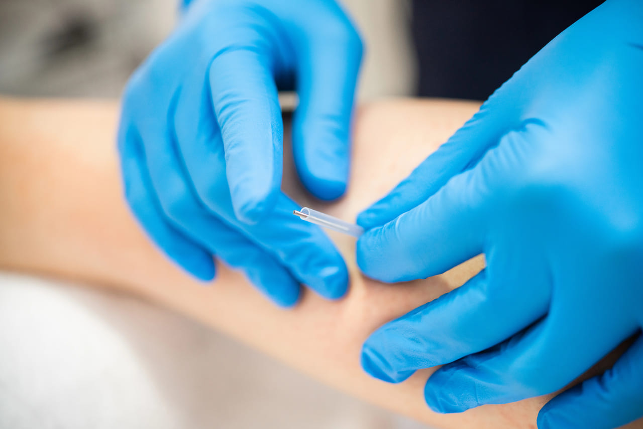 navigating your first dry needling experience desk workers chronic tension mississauga
